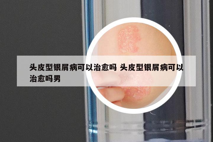 头皮型银屑病可以治愈吗 头皮型银屑病可以治愈吗男