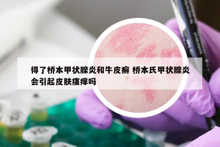 得了桥本甲状腺炎和牛皮癣 桥本氏甲状腺炎会引起皮肤瘙痒吗