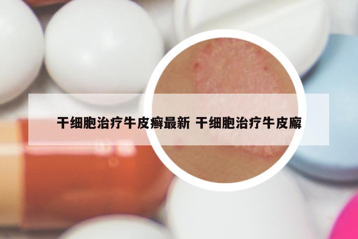 干细胞治疗牛皮癣最新 干细胞治疗牛皮廨