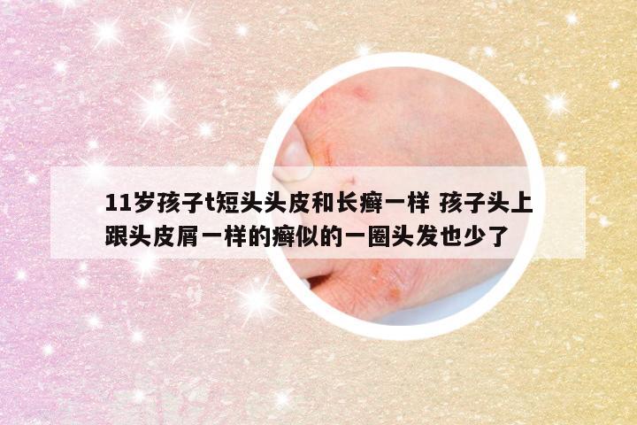 11岁孩子t短头头皮和长癣一样 孩子头上跟头皮屑一样的癣似的一圈头发也少了