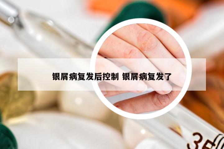 银屑病复发后控制 银屑病复发了