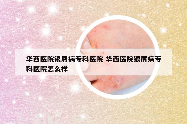 华西医院银屑病专科医院 华西医院银屑病专科医院怎么样