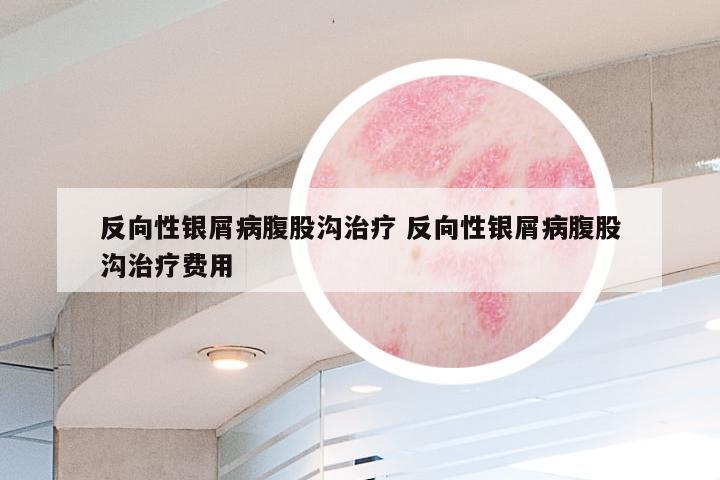 反向性银屑病腹股沟治疗 反向性银屑病腹股沟治疗费用