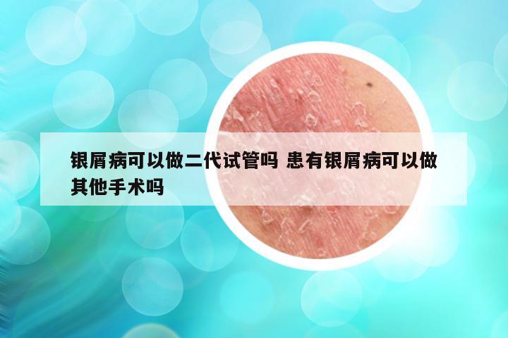 银屑病可以做二代试管吗 患有银屑病可以做其他手术吗