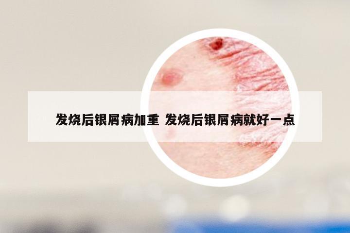 发烧后银屑病加重 发烧后银屑病就好一点