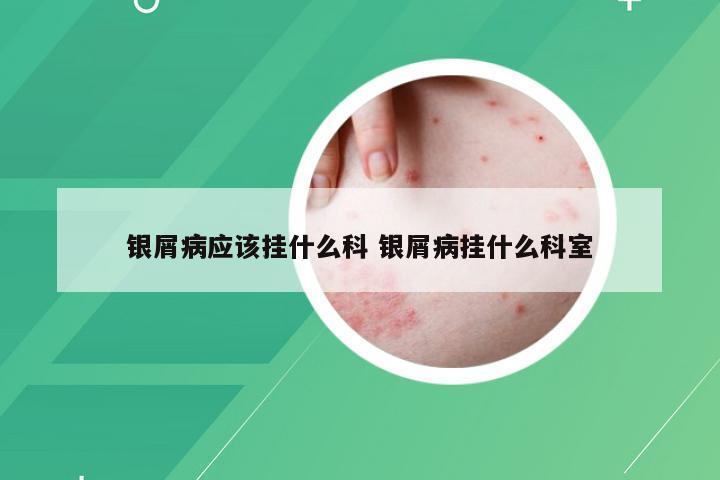 银屑病应该挂什么科 银屑病挂什么科室