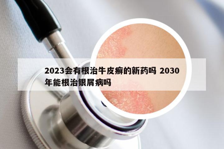 2023会有根治牛皮癣的新药吗 2030年能根治银屑病吗