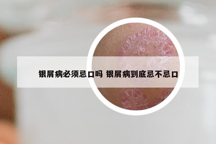 银屑病必须忌口吗 银屑病到底忌不忌口