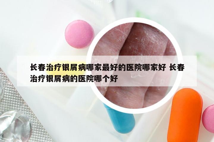 长春治疗银屑病哪家最好的医院哪家好 长春治疗银屑病的医院哪个好