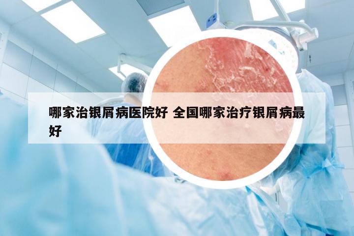 哪家治银屑病医院好 全国哪家治疗银屑病最好