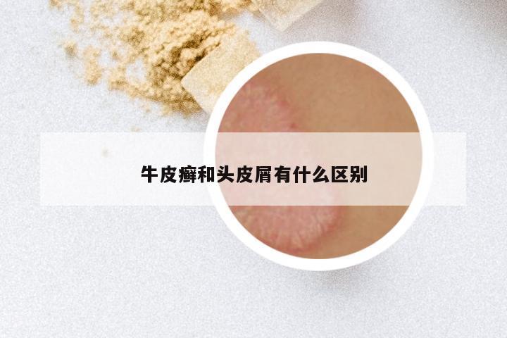 牛皮癣和头皮屑有什么区别