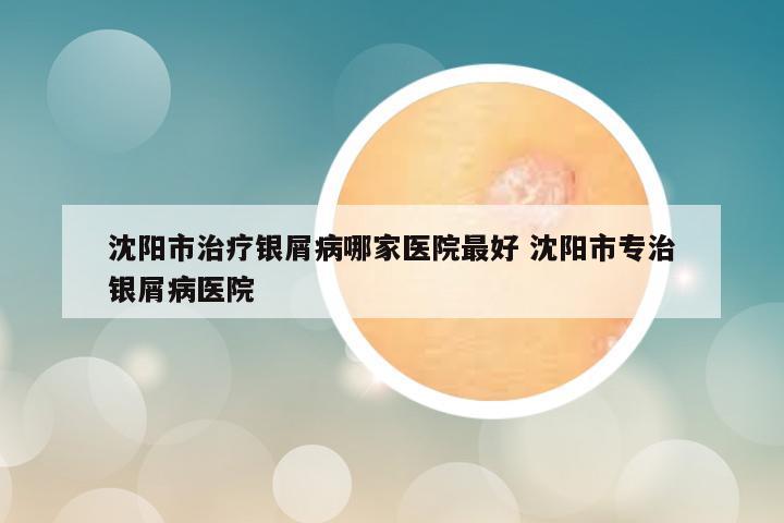 沈阳市治疗银屑病哪家医院最好 沈阳市专治银屑病医院