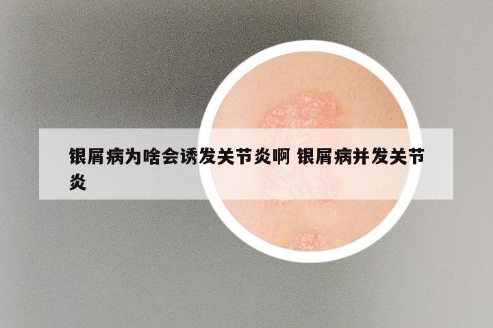 银屑病为啥会诱发关节炎啊 银屑病并发关节炎