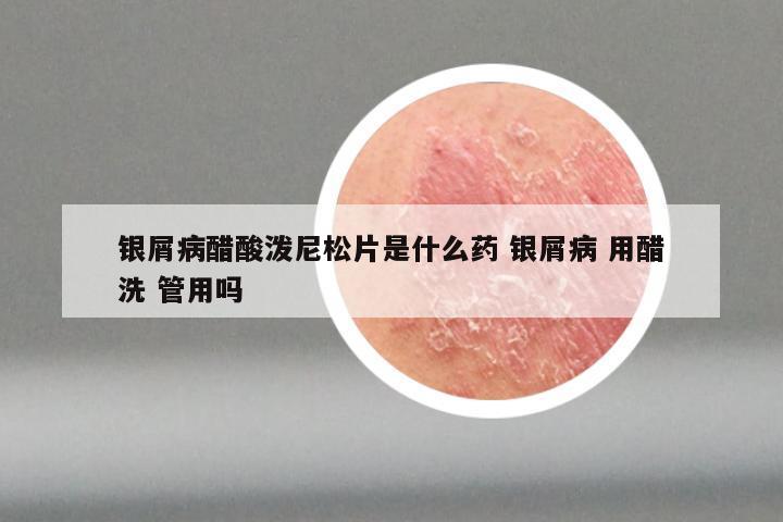 银屑病醋酸泼尼松片是什么药 银屑病 用醋洗 管用吗