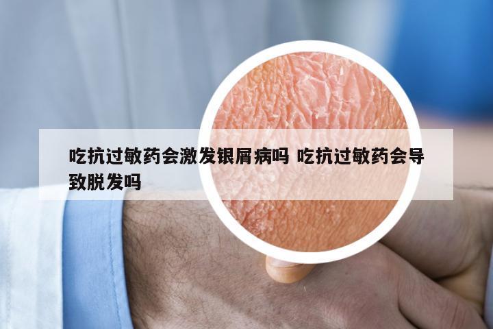 吃抗过敏药会激发银屑病吗 吃抗过敏药会导致脱发吗