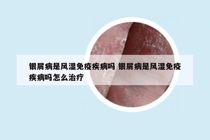 银屑病是风湿免疫疾病吗 银屑病是风湿免疫疾病吗怎么治疗