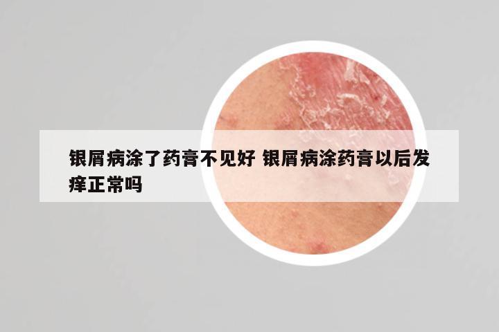 银屑病涂了药膏不见好 银屑病涂药膏以后发痒正常吗