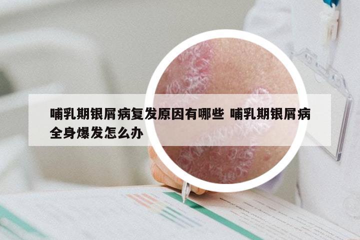 哺乳期银屑病复发原因有哪些 哺乳期银屑病全身爆发怎么办