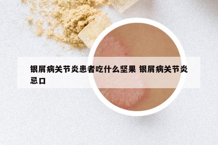 银屑病关节炎患者吃什么坚果 银屑病关节炎忌口