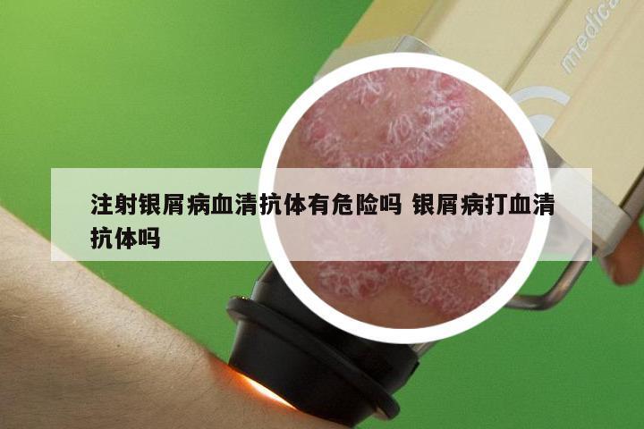 注射银屑病血清抗体有危险吗 银屑病打血清抗体吗