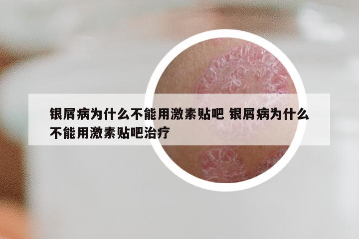 银屑病为什么不能用激素贴吧 银屑病为什么不能用激素贴吧治疗