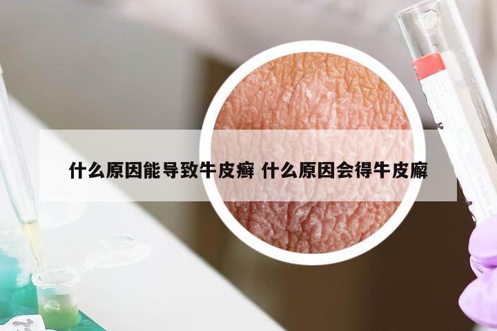 什么原因能导致牛皮癣 什么原因会得牛皮廨