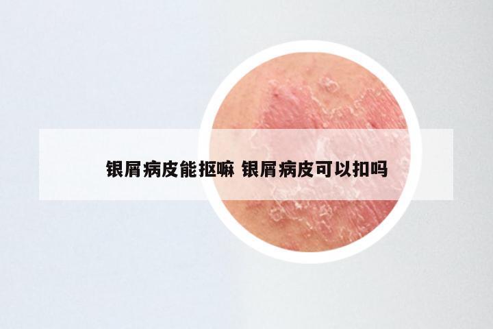 银屑病皮能抠嘛 银屑病皮可以扣吗