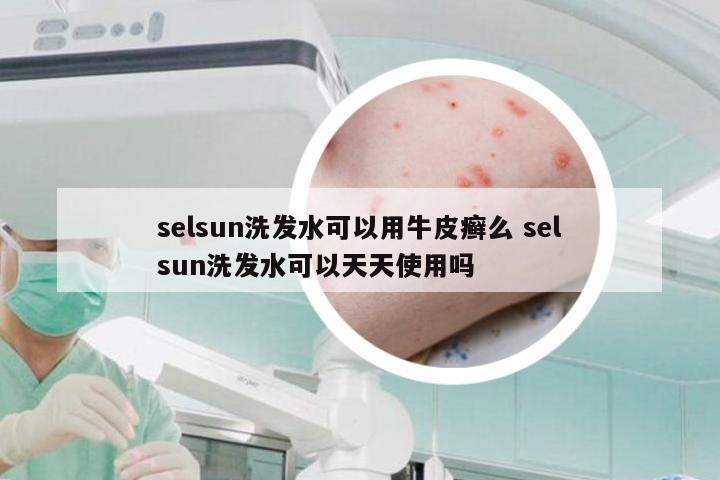 selsun洗发水可以用牛皮癣么 selsun洗发水可以天天使用吗