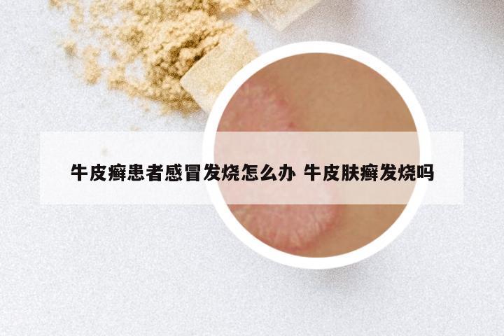 牛皮癣患者感冒发烧怎么办 牛皮肤癣发烧吗