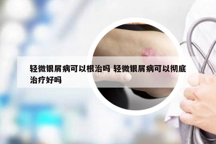 轻微银屑病可以根治吗 轻微银屑病可以彻底治疗好吗