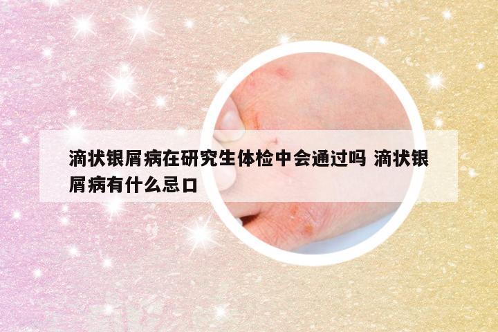 滴状银屑病在研究生体检中会通过吗 滴状银屑病有什么忌口