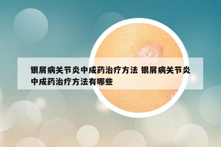 银屑病关节炎中成药治疗方法 银屑病关节炎中成药治疗方法有哪些