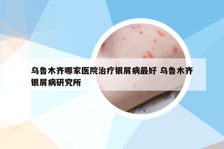 乌鲁木齐哪家医院治疗银屑病最好 乌鲁木齐银屑病研究所