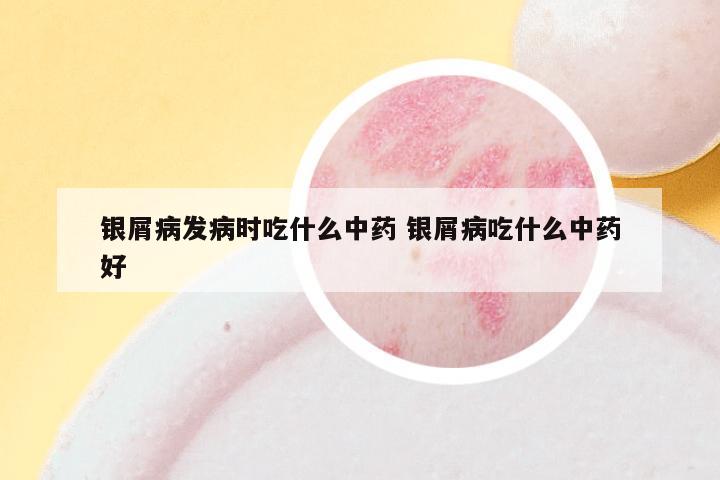 银屑病发病时吃什么中药 银屑病吃什么中药好