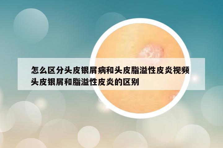 怎么区分头皮银屑病和头皮脂溢性皮炎视频 头皮银屑和脂溢性皮炎的区别