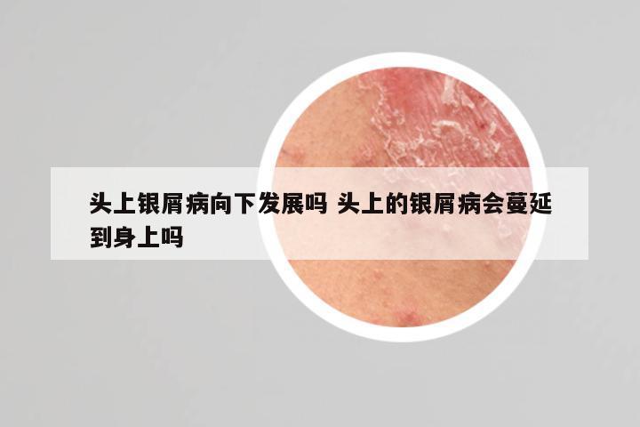 头上银屑病向下发展吗 头上的银屑病会蔓延到身上吗