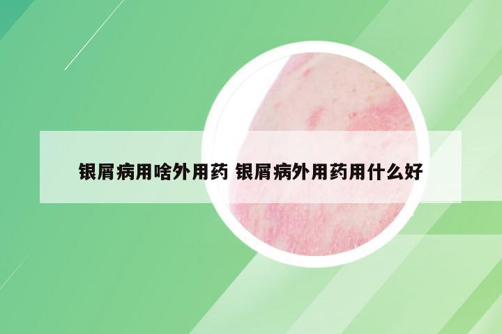 银屑病用啥外用药 银屑病外用药用什么好