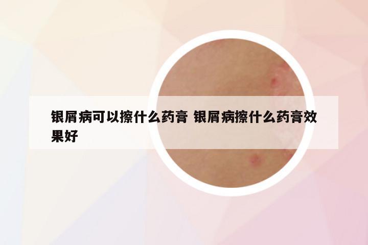 银屑病可以擦什么药膏 银屑病擦什么药膏效果好