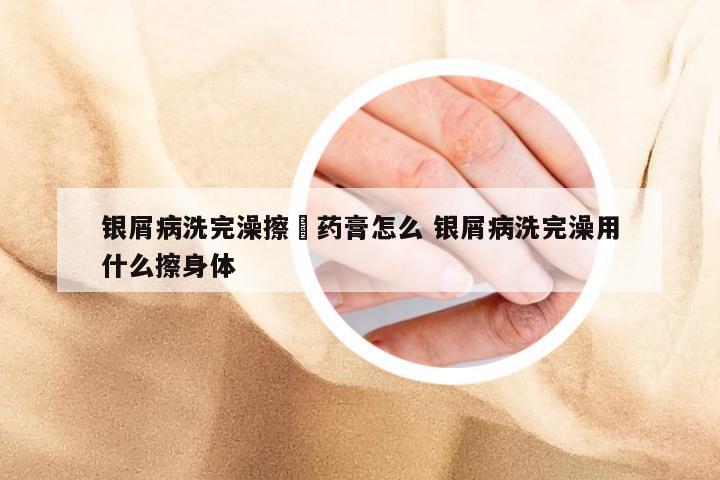 银屑病洗完澡擦廯药膏怎么 银屑病洗完澡用什么擦身体