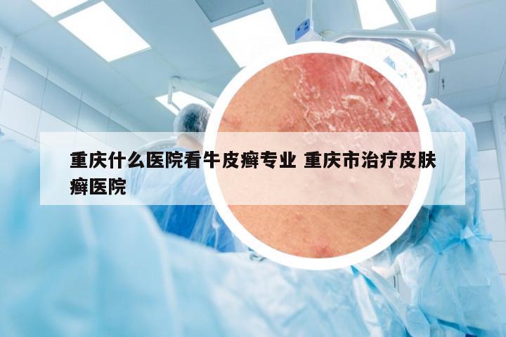 重庆什么医院看牛皮癣专业 重庆市治疗皮肤癣医院