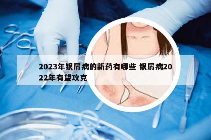 2023年银屑病的新药有哪些 银屑病2022年有望攻克