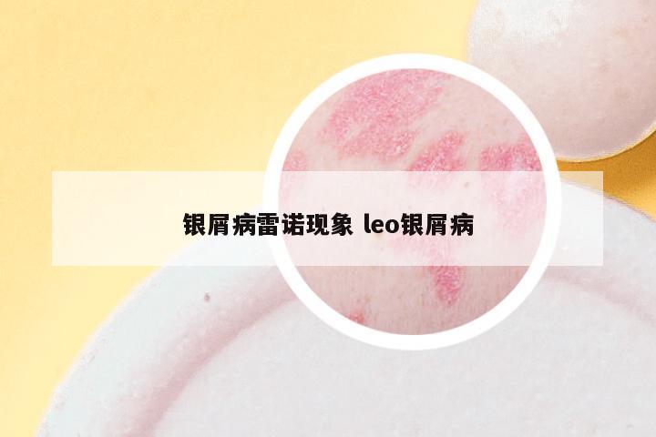 银屑病雷诺现象 leo银屑病