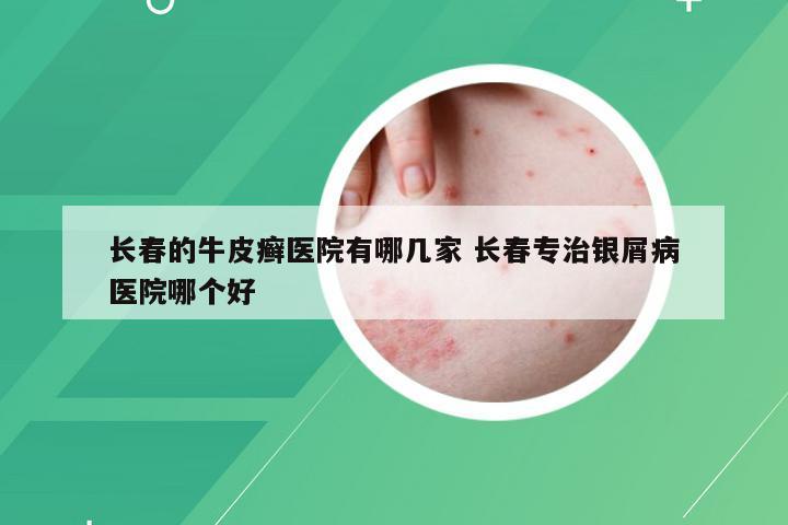 长春的牛皮癣医院有哪几家 长春专治银屑病医院哪个好