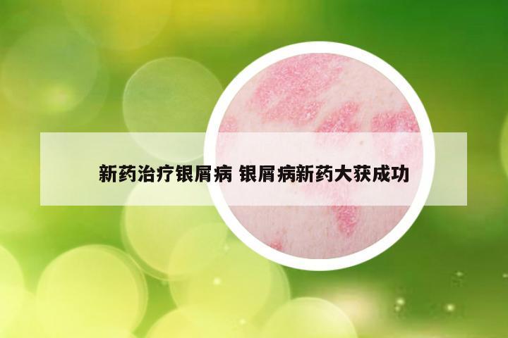 新药治疗银屑病 银屑病新药大获成功