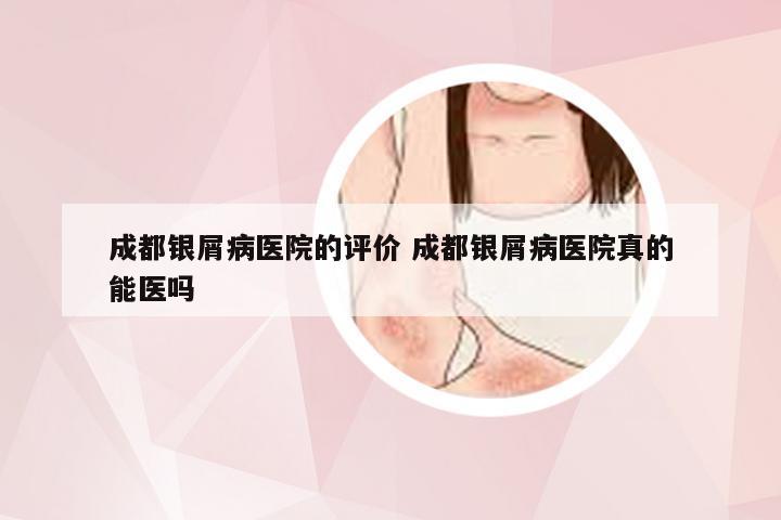 成都银屑病医院的评价 成都银屑病医院真的能医吗