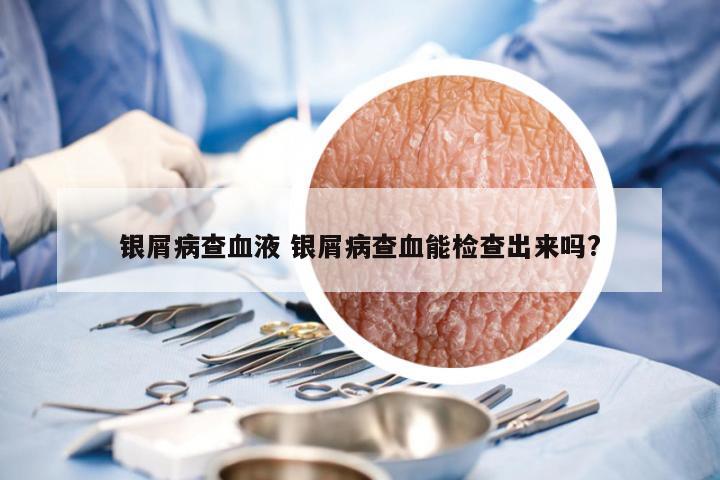 银屑病查血液 银屑病查血能检查出来吗?