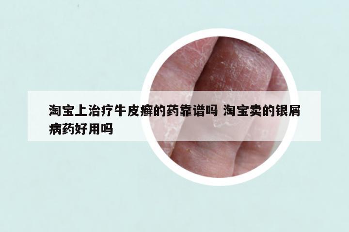 淘宝上治疗牛皮癣的药靠谱吗 淘宝卖的银屑病药好用吗