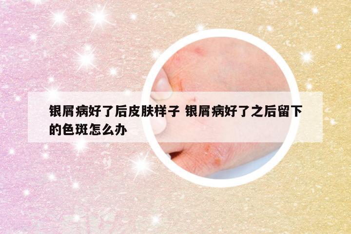 银屑病好了后皮肤样子 银屑病好了之后留下的色斑怎么办