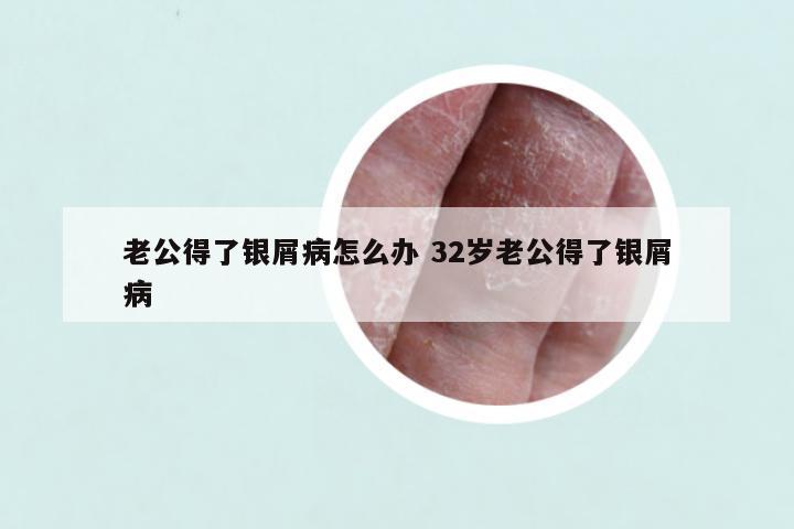 老公得了银屑病怎么办 32岁老公得了银屑病