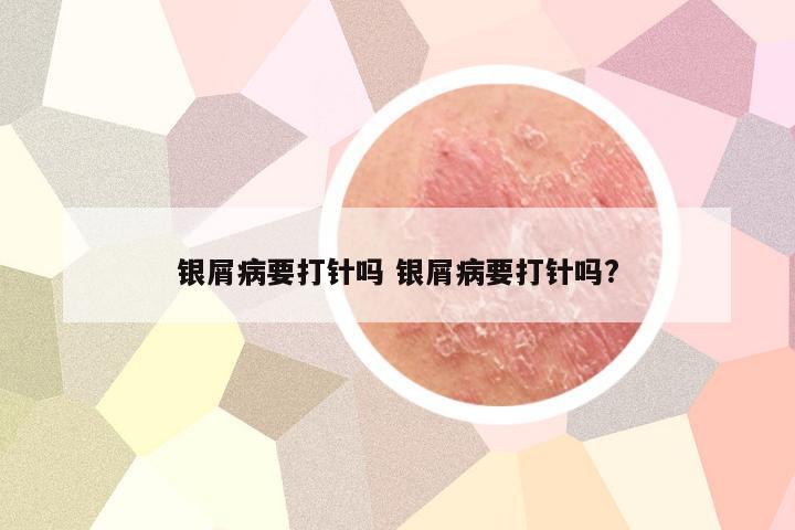 银屑病要打针吗 银屑病要打针吗?